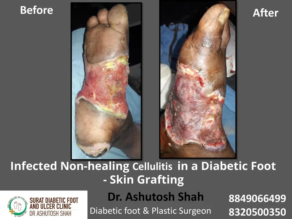 Diabetic Foot  PPT 3 checked by sir.pptx-4.webp